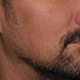Image for article titled Hipster Beard Transplants Are All the Rage These Days